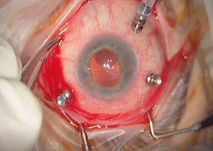 Iris Claw IOL Rescue After Blunt Trauma - Eyetube