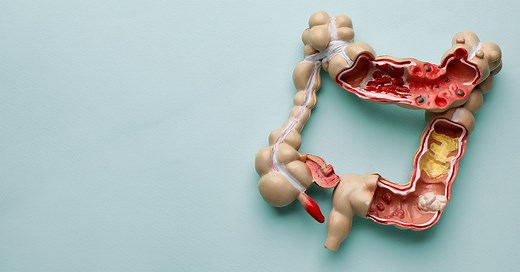 Colitis: Ulcerative, Ischemic, Microscopic and More