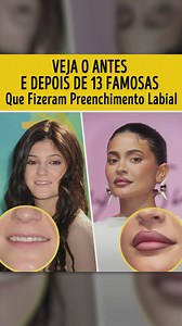 Veja o antes e depois de 13 famosas que fizeram preenchimento labial | Incrível Entertainment