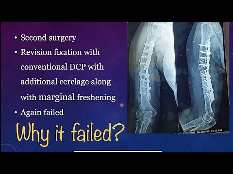 Shaft Humerus Non Union: A case based discussion