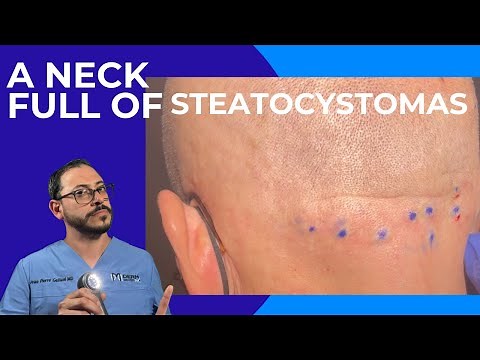 Neck full of steatocystomas . Full removal Dermatologist reacts and explains.