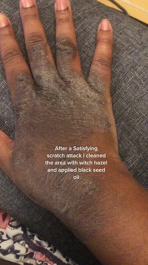 Eczema.and.me on TikTok