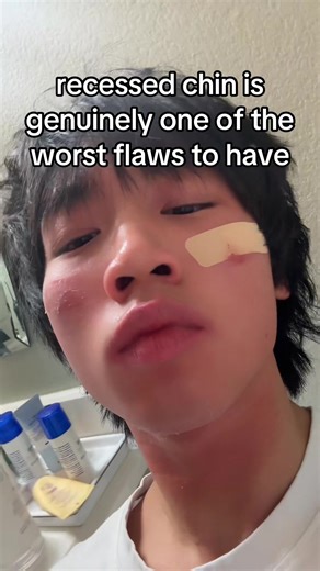 horrible tretinoin peel rn #recessed #jaw #looks | tretinoin