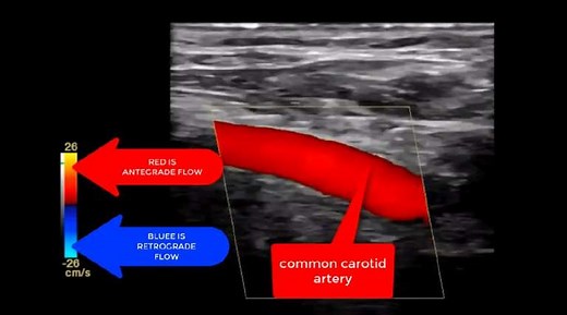 How To Diagnose Subclavian Steal Syndrome Course   CME Quiz - ABC Vascular