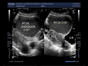 Ultrasound Video showing a Chocolate Ovarian Cyst.