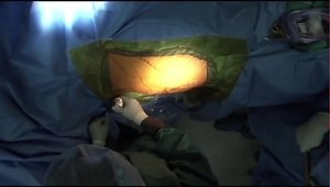 ANTERIOR ADVANTAGE™ Discussion - Draping the Hana® Table Bracket Prior to an Anterior Approach Procedure