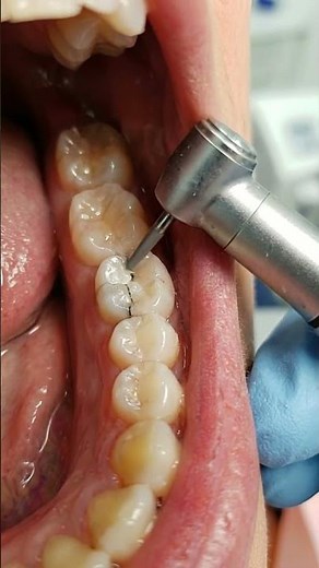 Inside a Silver Crown Placement 🦷 Fixing a Cracked Tooth | #toothcraft #asmr #satisfying