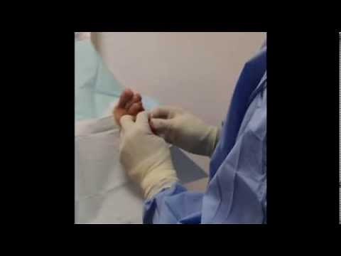 Removal of Painful Bone Spur