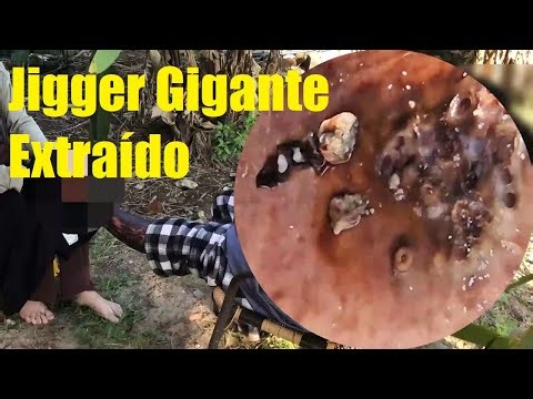 🔴🔥🦶 Shocking Jigger Infection | Foot Recovery Process 242462