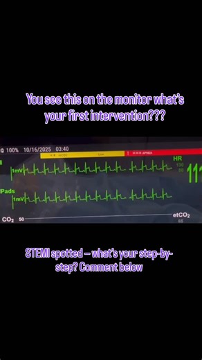 CriticalCareRN-Friend on Instagram: "🚨 STEMI Alert — What’s your first move? Classic tombstone ST elevation = nurse brain switches to go-mode. First step: get to the patient. ✅ 1. Full assessment • Full set of vitals • Check for chest pain • Ask about radiation (jaw, arm, back, shoulder) • Assess shortness of breath, diaphoresis, nausea • Apply defibrillator pads — STEMIs can decompensate fast ✅ 2. Notify provider IMMEDIATELY Right after your assessment, escalate: • “We have ST elevation on the