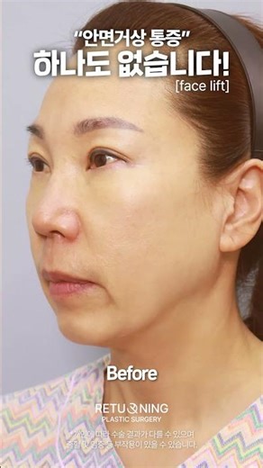 Honest Stories After Facelifts #ReturningPlasticSurgery #shorts #faceliftreview