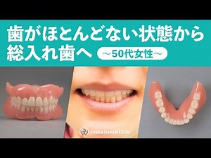 歯がほとんどない状態から総入れ歯へ〜50代女性〜