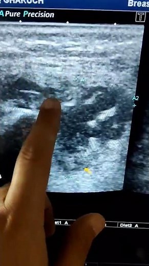 Submandibular Region Abscess on Ultrasound | Neck Swelling Case Study