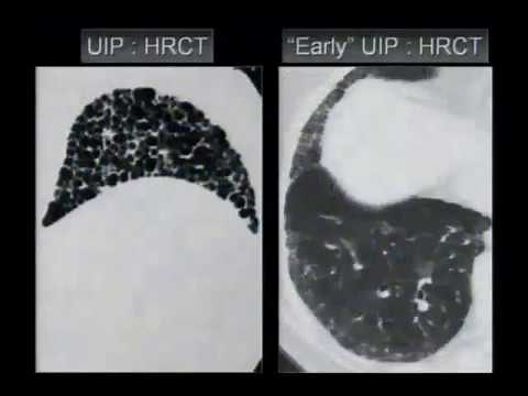HRCT CHEST - ILD