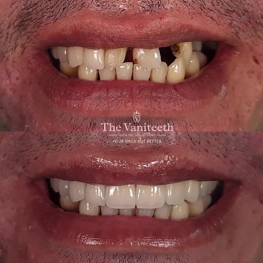 Advantages of Fixed Bridges for Missing Teeth