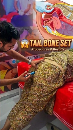 🔥 female tailbone adjustment! 😱 coccyx pain relief 💥coccydynia chiropractic treatment 💆‍♂️shorts