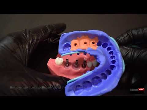 Impression Techniques for Implant Dentistry - | step by step | Closed tray Impression technique