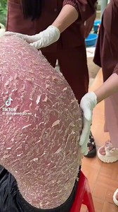 Exfoliative dermatitis (erythroderma) is a severe and potentially life-threatening inflammatory skin disorder characterized by widespread redness (erythema) and scaling that affects more than 90% of the body surface.