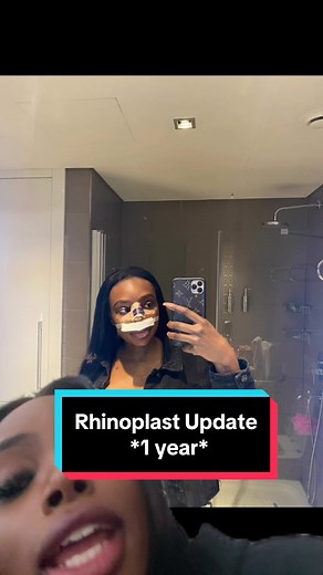 Rhinoplasty Update - 1 Year Mark