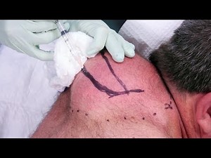 L'énorme boule de Paul - Docteur Pimple Popper
