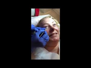Removal of a Skin Tag Under the Eye | Appearances Aesthetics