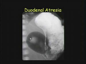 Pediatric Gastrointestinal