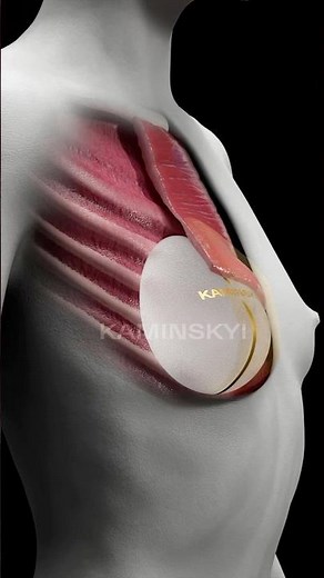 Anatomical implants under the muscle ⭕️ KAMINSKYI