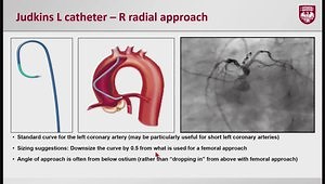 Guide Catheter Selection and Engagement in PCI: Optimal Guide Choice and Tips for Engagement