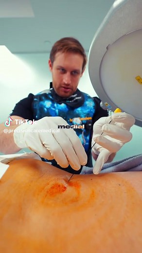How to relieve back pain? This was a radiofrequency ablation (RFA) performed after two successful medial branch blocks. Medial branch blocks are used to confirm whether the facet joints in the spine are the source of pain. If those diagnostic injections significantly reduce symptoms, it suggests the medial branch nerves are carrying the pain signals. RFA then targets those same nerves using controlled heat to reduce their ability to transmit pain signals. The goal is longer-lasting pain relief s