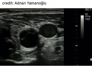Dissection with intimal flap extending into the proximal carotid artery. Most dissections begin with an intimal tear that allows the bloodstream direct access to the aortic wall. dissection usually occurs between the middle and outer layers of the media. Surgery can be down to repair the damaged wall with synthetic grafts. . . . . . . . . . #ultrasound #radiology #imaging #ultrasonido #medical #medicine #ultras #ultrasonography #mri #xray #doppler #health #radiologist #healthcare #ultrason #love