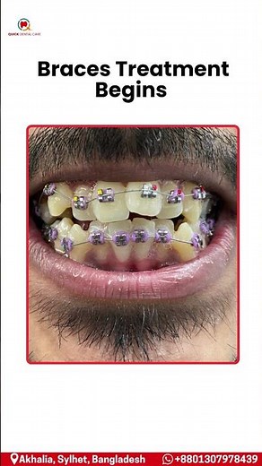 Braces Treatment Begins! A step closer to a perfectly aligned, confident smile. #foryou #shorts