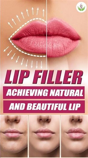 Lip Filler Trends 2025 💋 Natural Lip Enhancement & Micro-Dose Fillers Explained