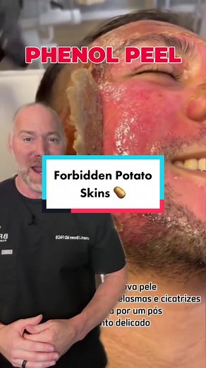 @drmadsonsales ‼️PHENOL PEEL‼️ … This is the deepest most effective type of chemical peel. … It can resolve harsh skin imperfections like acne scars, blotchiness, and coarse wrinkles. … PSA: DO NOT LET JUST ANYONE DO THIS TO YOU … Results can be lifelong. Just know. This is a controlled burn to the face. … 🎥 Credit: @drmadsonsales. Doc this is a good one. … #phenol #chemi#phenol #chemicalpeel #face #facialr#skini#skincarei#skincareroutiney#brownsanatomyn#wrinklesa#acneo#acnescarst#potatotatoski