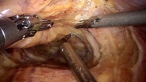 Robot-assisted Total Mesorectal Excision and Lateral Pelvic Lymph Node Dissection for Locally Advanced Middle-low Rectal Cancer