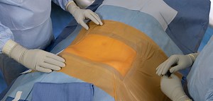 [Hot Item] Customized Sterile Disposable Surgical Film Drape