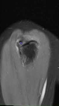 Acute Calcific Bursitis on MRI#msk#radiology#pain#mri#shoulder#calcium#rotatorcuff #anatomy