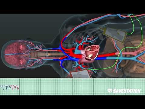 FRENCH: The AED in action | A 3D glimpse inside the body