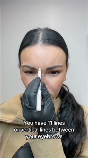 3 Reasons to get Botox between your eyebrows