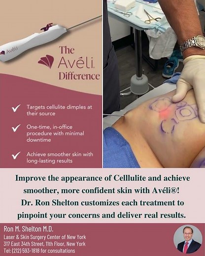 Aveli for cellulite reduction in NYC | Dr Ron Shelton #skincare #celluliteremoval