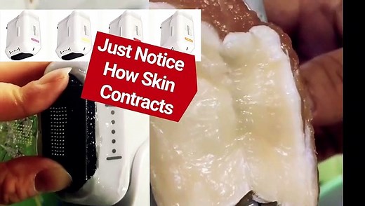 INTRODUCING 4D HIFU 4th Generation in Non Surgical Treatments