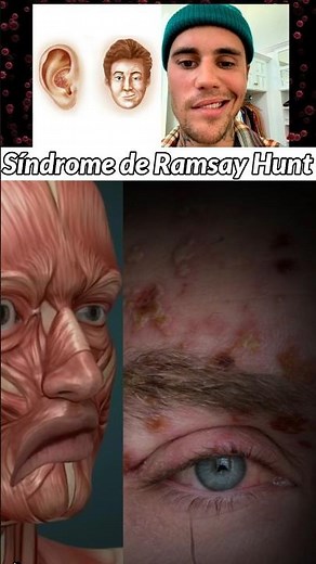 What is Ramsay Hunt syndrome and how does it affect your health?