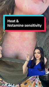 Heat & Histamine Sensitivity: Flushing, Itching, Hives Explained