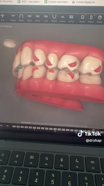 Understanding Crossbite: Causes and Correction Techniques