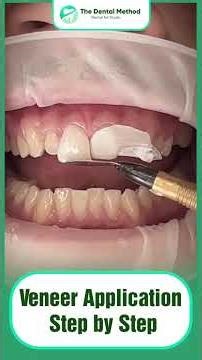 Veneer Application Step by step #dentalrestoration #caddentistry #rootcanaltreatment #veneers