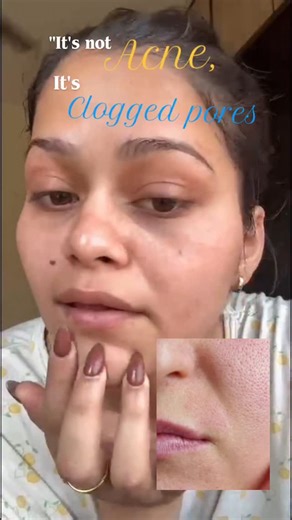 Tannu | skincare guide | beauty | lifestyle | ugc creator | ✅ What Are Clogged Pores? Clogged pores happen when dead skin cells, excess oil (sebum), dirt, and product buildup get trapped inside your... | Instagram