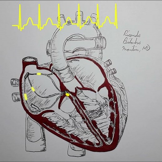 AVNRT explained in 40 seconds