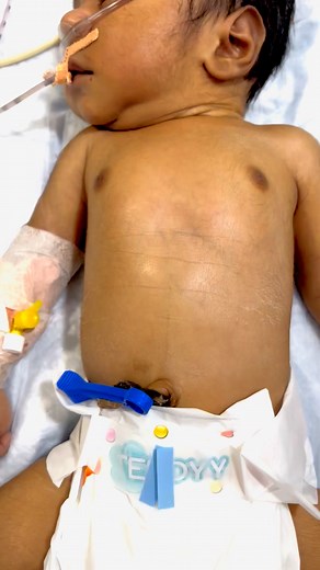 8.5K views · 102 reactions | Newborn respiratory distress syndrome #facebookreelsviral #treadingreel #baby #cutebaby #treatment #nicu #adorable | Sahib Ansari | Facebook