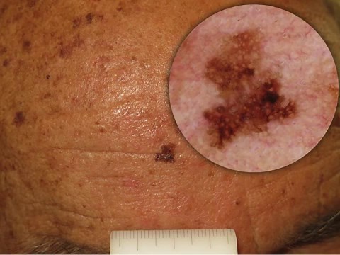 Solar lentigines / seborrheic keratoses / lichen planus-like keratosis - dermoscopedia