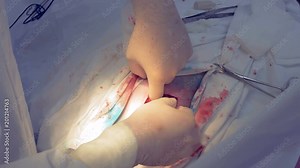 A surgeon is inserting an electronic device pacemaker, cardiac pacemaker, cardiostimulator into human body