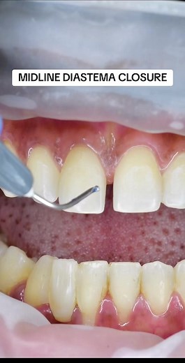Learn How to Close Midline Diastema with Dental Composite Bonding